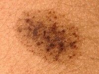Nevus spilus