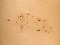 Nevus spilus