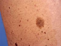 Nevus spilus