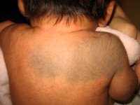 Nevus of Ito, Ito's nevus