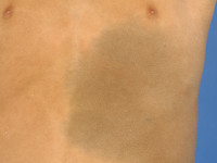 Nevus of Ito, Ito's nevus