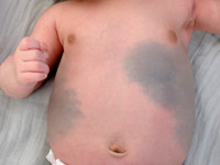 Naevus van Ito, Ito's nevus