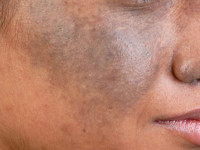Nevus of Ota, Ota's nevus
