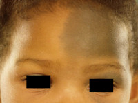 Nevus of Ota, Ota's nevus