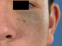 Nevus of Ota, Ota's nevus