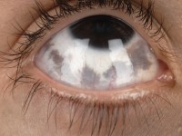 Nevus of Ota, Ota's nevus