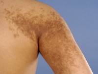 Becker's nevus