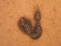 Naevus verrucosis