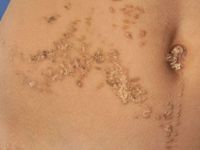 Naevus verrucosis unius lateris