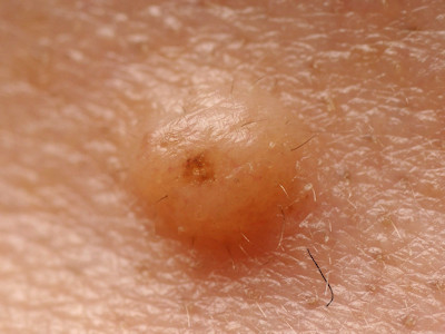 intradermal naevus
