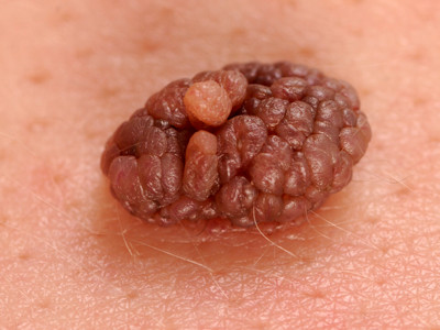 naevus naevocellularis papillomatosus