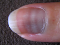 Mees' lines, dwarse strepen in de nagel