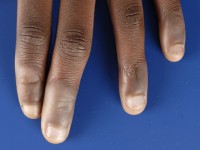 Acquired afrocarribean acrodorsal acanthosis