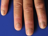 Acquired afrocarribean acrodorsal acanthosis