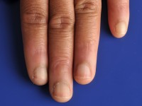 Acquired afrocarribean acrodorsal acanthosis