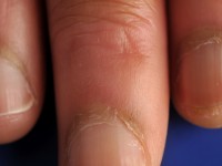 Acquired afrocarribean acrodorsal acanthosis