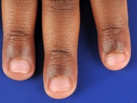 Acquired afrocarribean acrodorsal acanthosis