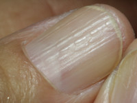 Onychorrhexis en beading