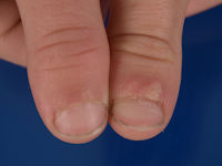 Brachyonychia (korte nagels) bij acro-osteolysis