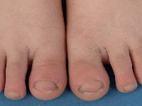 Brachyonychia (korte nagels) bij acro-osteolysis