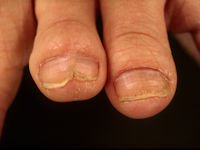 Korte nagels bij ectodermale dysplasie