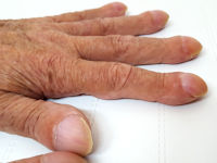 Clubbed fingers, nail clubbing, trommelstokvingers