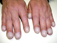 Clubbed fingers, nail clubbing, trommelstokvingers