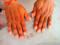 Clubbed fingers, nail clubbing, trommelstokvingers