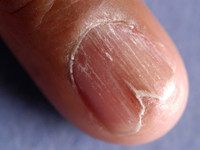 Distal onycholysis and wedge-shaped notches in Darier