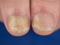 Distale onycholysis bij alopecia areata