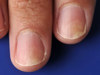 Distale onycholysis bij fototoxische reactie op doxycycline