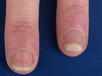 Distale onycholysis bij morfea