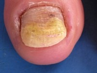 Distale onycholysis bij mycose