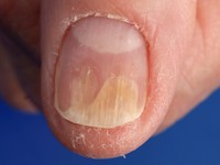 Distale onycholysis bij pityriasis rubra pilaris