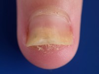 Distale onycholysis bij psoriasis
