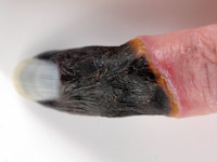 Blauwe nagel bij acute ischemie