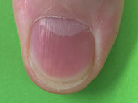 Erythronychia, rode nagels