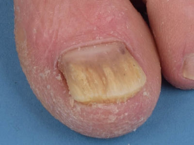 Hyperkeratose bij pityriasis rubra pilaris