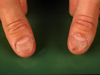 Koilonychia (lepeltjesnagels)