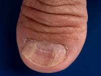 Koilonychia (lepeltjesnagels)