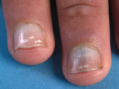 Leukonychia