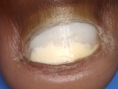 Leukonychia totalis
