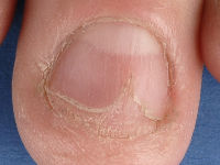 Dunne nagels bij lichen planus