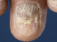 Hyperkeratose en dystrofie bij lichen planus