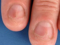 Mediane splijting nagel en proximale bolling en erytheem bij lichen planus