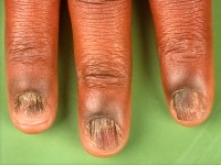 Longitudinale groeven bij lichen planus nagels