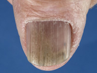 Onychorrhexis bij lichen planus