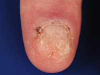 Onychorrhexis bij lichen planus