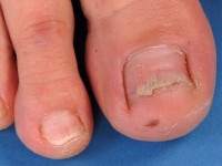 Transversale groeven bij lichen planus