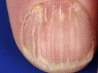 Longitudinale groeven